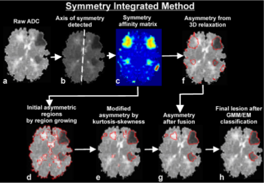 Symmetry integrated region growing (SIRG) based lesion detection.